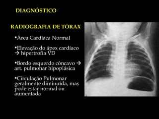 DIAGNÓSTICO Área Cardíaca Normal Elevação do ápex cardíaco    hipertrofia VD Bordo esquerdo côncavo    art. pulmonar hipoplásica Circulação Pulmonar geralmente diminuída, mas pode estar normal ou aumentada RADIOGRAFIA DE TÓRAX 
