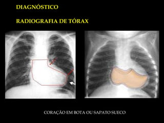 DIAGNÓSTICO CORAÇÃO EM BOTA OU SAPATO SUECO RADIOGRAFIA DE TÓRAX 