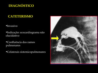 DIAGNÓSTICO TAP INF VD Invasivo Indicação: ecocardiograma não elucidativo Confluência dos ramos pulmonares Colaterais sistemicopulmonares CATETERISMO 