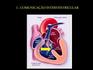 1.- COMUNICAÇÃO INTERVENTRICULAR 