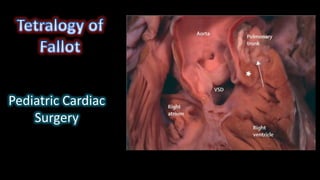 Pediatric Cardiac
Surgery
 