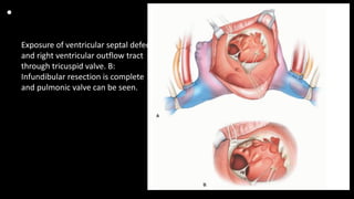 •
Exposure of ventricular septal defect
and right ventricular outflow tract
through tricuspid valve. B:
Infundibular resection is complete
and pulmonic valve can be seen.
 