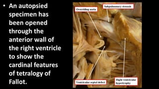 • An autopsied
specimen has
been opened
through the
anterior wall of
the right ventricle
to show the
cardinal features
of tetralogy of
Fallot.
 