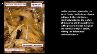 •
In this specimen, opened in the
same fashion as the heart shown
in Figure 1, there is fibrous
continuity between the leaflets
of the aortic and tricuspid valves
in the postero-inferior margin of
the ventricular septal defect,
making the defect itself
perimembranous
 