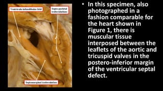 • In this specimen, also
photographed in a
fashion comparable for
the heart shown in
Figure 1, there is
muscular tissue
interposed between the
leaflets of the aortic and
tricuspid valves in the
postero-inferior margin
of the ventricular septal
defect.
 