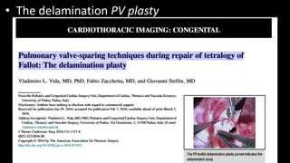 • The delamination PV plasty
 