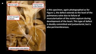 •
n this specimen, again photographed as for
Figure 1, the defect extends to the level of the
pulmonary valve due to failure of
muscularisation of the outlet septum during
development of the heart. This type of defect
is doubly committed and juxtaarterial, but is
also perimembranous.
 