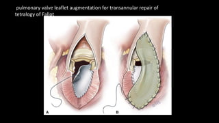 pulmonary valve leaflet augmentation for transannular repair of
tetralogy of Fallot
 