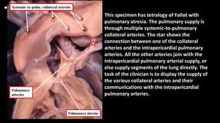 •
This specimen has tetralogy of Fallot with
pulmonary atresia. The pulmonary supply is
through multiple systemic-to-pulmonary
collateral arteries. The star shows the
connection between one of the collateral
arteries and the intrapericardial pulmonary
arteries. All the other arteries join with the
intrapericardial pulmonary arterial supply, or
else supply segments of the lung directly. The
task of the clinician is to display the supply of
the various collateral arteries and their
communications with the intrapericardial
pulmonary arteries.
 