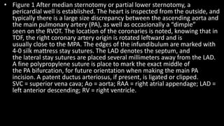 • Figure 1 After median sternotomy or partial lower sternotomy, a
pericardial well is established. The heart is inspected from the outside, and
typically there is a large size discrepancy between the ascending aorta and
the main pulmonary artery (PA), as well as occasionally a “dimple”
seen on the RVOT. The location of the coronaries is noted, knowing that in
TOF, the right coronary artery origin is rotated leftward and is
usually close to the MPA. The edges of the infundibulum are marked with
4-0 silk mattress stay sutures. The LAD denotes the septum, and
the lateral stay sutures are placed several millimeters away from the LAD.
A fine polypropylene suture is place to mark the exact middle of
the PA bifurcation, for future orientation when making the main PA
incision. A patent ductus arteriosus, if present, is ligated or clipped.
SVC = superior vena cava; Ao = aorta; RAA = right atrial appendage; LAD =
left anterior descending; RV = right ventricle.
 