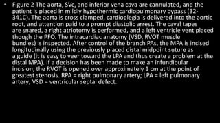 • Figure 2 The aorta, SVc, and inferior vena cava are cannulated, and the
patient is placed in mildly hypothermic cardiopulmonary bypass (32-
341C). The aorta is cross clamped, cardioplegia is delivered into the aortic
root, and attention paid to a prompt diastolic arrest. The caval tapes
are snared, a right atriotomy is performed, and a left ventricle vent placed
though the PFO. The intracardiac anatomy (VSD, RVOT muscle
bundles) is inspected. After control of the branch PAs, the MPA is incised
longitudinally using the previously placed distal midpoint suture as
a guide (it is easy to veer toward the LPA and thus create a problem at the
distal MPA). If a decision has been made to make an infundibular
incision, the RVOT is opened over approximately 1 cm at the point of
greatest stenosis. RPA = right pulmonary artery; LPA = left pulmonary
artery; VSD = ventricular septal defect.
 