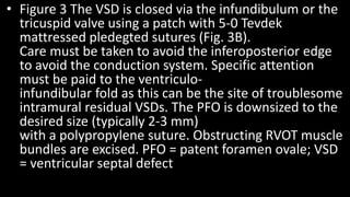 • Figure 3 The VSD is closed via the infundibulum or the
tricuspid valve using a patch with 5-0 Tevdek
mattressed pledegted sutures (Fig. 3B).
Care must be taken to avoid the inferoposterior edge
to avoid the conduction system. Specific attention
must be paid to the ventriculo-
infundibular fold as this can be the site of troublesome
intramural residual VSDs. The PFO is downsized to the
desired size (typically 2-3 mm)
with a polypropylene suture. Obstructing RVOT muscle
bundles are excised. PFO = patent foramen ovale; VSD
= ventricular septal defect
 