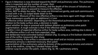 • Figure 4 Attention is now directed toward the RVOT and pulmonary valve. The pulmonary
valve is inspected and the number of cusps, their
consistency, the level of fusion, thickness, and the depth of the sinuses of Valsalva are
noted. A Hegar dilator is passed to measure the effective
orifice, NOT to dilate the valve. The cusps are thinned out gently, and each commissure is
incised with a no. 15 scalpel blade down to the
medial layers. Measure of the new effective orifice is now done again with Hegar dilators.
These maneuvers usually gain an additional 1-2 mm
in effective orifice diameter. Depending on the theoretical pulmonary annular size in
relation to the body surface area, a decision is made
about whether to stop or proceed with balloon dilation or pulmonary valve patch
augmentation. A rough estimate is that if the effective orifice
is within 1 mm of expected effective orifice for body surface area, nothing else is done. If
the effective orifice is o2 mm from expected, slow
and deliberate hand-controlled balloon dilation (Fig. 5) using as a first balloon diameter the
size of the orifice measured after sharp
commissurotomy. If the orifice is considered too small and an incision across the
pulmonary annulus is deemed necessary, then patch
augmentation of the pulmonary valve by division of the pulmonary annulus and anterior
cusp in the midline, using the 2 divided halves of the
anterior cusp to anchor the patch, is done (Fig. 6). PA = pulmonary artery.
 