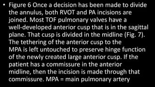 • Figure 6 Once a decision has been made to divide
the annulus, both RVOT and PA incisions are
joined. Most TOF pulmonary valves have a
well-developed anterior cusp that is in the sagittal
plane. That cusp is divided in the midline (Fig. 7).
The tethering of the anterior cusp to the
MPA is left untouched to preserve hinge function
of the newly created large anterior cusp. If the
patient has a commissure in the anterior
midline, then the incision is made through that
commissure. MPA = main pulmonary artery
 