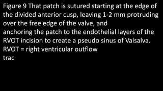 Figure 9 That patch is sutured starting at the edge of
the divided anterior cusp, leaving 1-2 mm protruding
over the free edge of the valve, and
anchoring the patch to the endothelial layers of the
RVOT incision to create a pseudo sinus of Valsalva.
RVOT = right ventricular outflow
trac
 