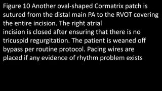 Figure 10 Another oval-shaped Cormatrix patch is
sutured from the distal main PA to the RVOT covering
the entire incision. The right atrial
incision is closed after ensuring that there is no
tricuspid regurgitation. The patient is weaned off
bypass per routine protocol. Pacing wires are
placed if any evidence of rhythm problem exists
 