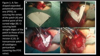 Figure 1. A: fan-
shaped expanded
polytetrafluoroethyl
ene (PTFE). B:
suturing the vertex
of the patch (A) and
central point of the
curved edge (B). C:
suturing both
straight edges of the
patch to those of the
ventriculotomy
incision (C,D). D:
transannular patch
of autologous
pericardium
(covering the PTFE
valve).
 