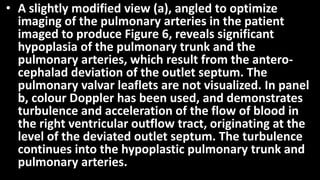 • A slightly modified view (a), angled to optimize
imaging of the pulmonary arteries in the patient
imaged to produce Figure 6, reveals significant
hypoplasia of the pulmonary trunk and the
pulmonary arteries, which result from the antero-
cephalad deviation of the outlet septum. The
pulmonary valvar leaflets are not visualized. In panel
b, colour Doppler has been used, and demonstrates
turbulence and acceleration of the flow of blood in
the right ventricular outflow tract, originating at the
level of the deviated outlet septum. The turbulence
continues into the hypoplastic pulmonary trunk and
pulmonary arteries.
 