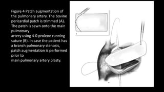 Figure 4 Patch augmentation of
the pulmonary artery. The bovine
pericardial patch is trimmed (A).
The patch is sewn onto the main
pulmonary
artery using 4-0 prolene running
suture (B). In case the patient has
a branch pulmonary stenosis,
patch augmentation is performed
prior to
main pulmonary artery plasty.
 