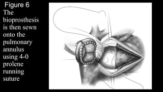 Figure 6
The
bioprosthesis
is then sewn
onto the
pulmonary
annulus
using 4-0
prolene
running
suture
 