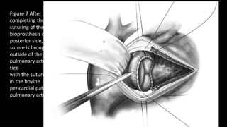 Figure 7 After
completing the
suturing of the
bioprosthesis on the
posterior side, the
suture is brought
outside of the
pulmonary artery and
tied
with the suture used
in the bovine
pericardial patch for
pulmonary artery.
 