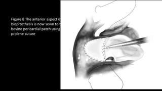 Figure 8 The anterior aspect of
bioprosthesis is now sewn to the
bovine pericardial patch using 4-0
prolene suture
 