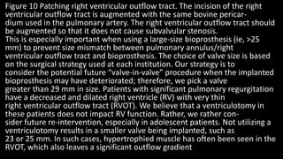 Figure 10 Patching right ventricular outflow tract. The incision of the right
ventricular outflow tract is augmented with the same bovine pericar-
dium used in the pulmonary artery. The right ventricular outflow tract should
be augmented so that it does not cause subvalvular stenosis.
This is especially important when using a large-size bioprosthesis (ie, >25
mm) to prevent size mismatch between pulmonary annulus/right
ventricular outflow tract and bioprosthesis. The choice of valve size is based
on the surgical strategy used at each institution. Our strategy is to
consider the potential future “valve-in-valve” procedure when the implanted
bioprosthesis may have deteriorated; therefore, we pick a valve
greater than 29 mm in size. Patients with significant pulmonary regurgitation
have a decreased and dilated right ventricle (RV) with very thin
right ventricular outflow tract (RVOT). We believe that a ventriculotomy in
these patients does not impact RV function. Rather, we rather con-
sider future re-intervention, especially in adolescent patients. Not utilizing a
ventriculotomy results in a smaller valve being implanted, such as
23 or 25 mm. In such cases, hypertrophied muscle has often been seen in the
RVOT, which also leaves a significant outflow gradient
 