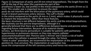 Figure 11 Comparison of aortic and 29 mm mitral bioprosthesis. The length from the
cuff to the top of the valve (the supravalvular part of bio-
prosthesis) is lower (ie, low profile) in the mitral compared to the aortic (9 mm vs 11
mm). This smaller size is important to ensure the stent
posts do not interfere with the bifurcation of the pulmonary artery, which could
result in branch pulmonary artery stenosis. The cuff is thicker
in the mitral compared to the aortic (4 mm vs 2 mm), which makes it physically easier
to implant the bioprosthesis. Other than these features,
the basic structure is not different between the aortic and the mitral bioprosthesis.
We routinely use the porcine bioprosthesis, although it is
generally believed that there are no differences between bovine and porcine valves
regarding future intervention. Because of its material charac-
teristics, we think bovine pericardium is suitable for patients with pulmonary
hypertension or pulmonary stenosis as they may require catheter
assessment/treatment later. Porcine valve is thinner and it bears a risk of leaflet
injury when the catheter is passed through the valve. For future
“valve in valve” procedure, we recommend the implantation at the anatomical
position (ie, true annulus). The implantation at supravalve may
cause the compression of the left coronary artery and hence not recommended
 