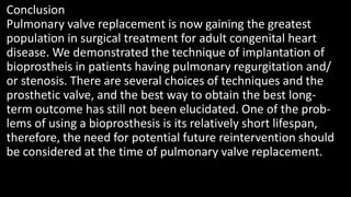 Conclusion
Pulmonary valve replacement is now gaining the greatest
population in surgical treatment for adult congenital heart
disease. We demonstrated the technique of implantation of
bioprostheis in patients having pulmonary regurgitation and/
or stenosis. There are several choices of techniques and the
prosthetic valve, and the best way to obtain the best long-
term outcome has still not been elucidated. One of the prob-
lems of using a bioprosthesis is its relatively short lifespan,
therefore, the need for potential future reintervention should
be considered at the time of pulmonary valve replacement.
 