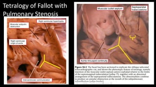 Tetralogy of Fallot with
Pulmonary Stenosis
 