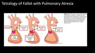 Tetralogy of Fallot with Pulmonary Atresia
 