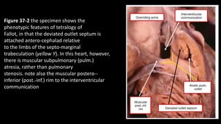 Figure 37-2 the specimen shows the
phenotypic features of tetralogy of
Fallot, in that the deviated outlet septum is
attached antero-cephalad relative
to the limbs of the septo-marginal
trabeculation (yellow Y). In this heart, however,
there is muscular subpulmonary (pulm.)
atresia, rather than pulmonary
stenosis. note also the muscular postero--
inferior (post.-inf.) rim to the interventricular
communication
 