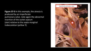 Figure 37-3 In this example, the atresia is
produced by an imperforate
pulmonary valve. note again the abnormal
insertion of the outlet septum
(star) relative to the septo-marginal
trabeculation (yellow Y).
 