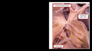 Figure 37-4 In this heart, the pulmonary
trunk is represented by a fibrous
strand, but the strand takes its origin from
the right ventricle. the aortic
valve is attached directly to the parietal
ventricular wall, with no evidence
of the subpulmonary infundibulum. the
yellow Y shows the septo-marginal
trabeculation
 
