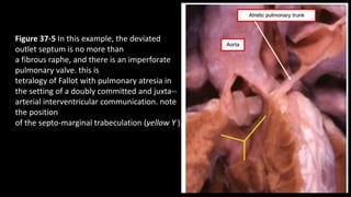 Figure 37-5 In this example, the deviated
outlet septum is no more than
a fibrous raphe, and there is an imperforate
pulmonary valve. this is
tetralogy of Fallot with pulmonary atresia in
the setting of a doubly committed and juxta--
arterial interventricular communication. note
the position
of the septo-marginal trabeculation (yellow Y ).
 