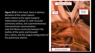 Figure 37-6 In this heart, there is obvious
deviation of the outlet septum
(star) relative to the septo-marginal
trabeculation (yellow Y ), with muscular
pulmonary atresia, and a perimembranous
interventricular communication.
note the fibrous continuity between the
leaflets of the aortic and tricuspid
(tric.) valves, and the seagull configuration of
the pulmonary arteries
 