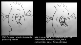 VSD+Pulmonary atresia+Hypoplastic
pulmonary arteries
MPA is transected at the right ventricular end
and clamped. Pulmonary blood flow is
maintained by patent ductus arteriosus.
 