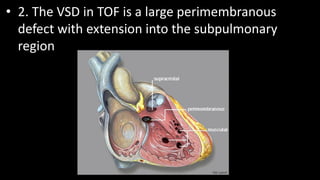 • 2. The VSD in TOF is a large perimembranous
defect with extension into the subpulmonary
region
 