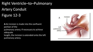 Right Ventricle–to–Pulmonary
Artery Conduit
Figure 12-3
A An incision is made into the confluent
portion of the
pulmonary artery. If necessary to achieve
adequate
length, the incision is extended onto the left
pulmonary artery.
 