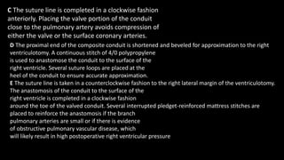 C The suture line is completed in a clockwise fashion
anteriorly. Placing the valve portion of the conduit
close to the pulmonary artery avoids compression of
either the valve or the surface coronary arteries.
D The proximal end of the composite conduit is shortened and beveled for approximation to the right
ventriculotomy. A continuous stitch of 4/0 polypropylene
is used to anastomose the conduit to the surface of the
right ventricle. Several suture loops are placed at the
heel of the conduit to ensure accurate approximation.
E The suture line is taken in a counterclockwise fashion to the right lateral margin of the ventriculotomy.
The anastomosis of the conduit to the surface of the
right ventricle is completed in a clockwise fashion
around the toe of the valved conduit. Several interrupted pledget-reinforced mattress stitches are
placed to reinforce the anastomosis if the branch
pulmonary arteries are small or if there is evidence
of obstructive pulmonary vascular disease, which
will likely result in high postoperative right ventricular pressure
 