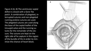Figure 4 (A, B) The ventricular septal
defect is closed with a Gore-Tex
patch. A combination of plegeted, in-
terrupted sutures and non-plegeted
running prolene sutures are used.
The plegeted sutures are used along
the base of the septal leaflet of the
tricuspid valve and the running su-
tures for the remainder of the clo-
sure. The sutures are kept on the
right side of he septum in the region
of the bundle of His in order to min-
imize the chance of heart block.
 