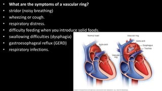 • What are the symptoms of a vascular ring?
• stridor (noisy breathing)
• wheezing or cough.
• respiratory distress.
• difficulty feeding when you introduce solid foods.
• swallowing difficulties (dysphagia)
• gastroesophageal reflux (GERD)
• respiratory infections.
 