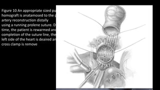 Figure 10 An appropriate sized pulmonary
homograft is anatamosed to the pulmonary
artery reconstruction distally
using a running prolene suture. During this
time, the patient is rewarmed and at the
completion of the suture line, the
left side of the heart is deaired and the aortic
cross clamp is remove
 