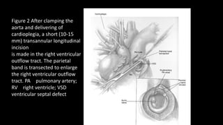 Figure 2 After clamping the
aorta and delivering of
cardioplegia, a short (10-15
mm) transannular longitudinal
incision
is made in the right ventricular
outflow tract. The parietal
band is transected to enlarge
the right ventricular outflow
tract. PA pulmonary artery;
RV right ventricle; VSD
ventricular septal defect
 