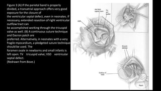 Figure 3 (A) If the parietal band is properly
divided, a transatrial approach offers very good
exposure for the closure of
the ventricular septal defect, even in neonates. If
necessary, extended resection of right ventricular
outflow tract can
be accomplished working through the tricuspid
valve as well. (B) A continuous suture technique
and Dacron patch are
preferred. Alternatively, in neonates with a very
fragile myocardium, a pledgeted suture technique
should be used. The
foramen ovale in newborns and small infants is
left open. TV tricuspid valve; VSD ventricular
septal defect.
(Redrawn from Bove.)
 
