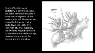 Figure 4 The transverse
aortotomy is performed above
the aortic valve commissures. A
short tubular segment of the
aorta is resected. This maneuver
brings the future ascending
aorta down and to the left.
Resection of aorta, especially
in newborns, might be omitted,
to avoid too close a relationship
between the aorta and the
trachea and left bronchus.
 