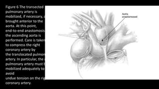 Figure 6 The transected
pulmonary artery is
mobilized, if necessary, and
brought anterior to the
aorta. At this point,
end-to-end anastomosis of
the ascending aorta is
performed. Care is taken not
to compress the right
coronary artery by
the translocated pulmonary
artery. In particular, the right
pulmonary artery must be
mobilized adequately to
avoid
undue tension on the right
coronary artery.
 