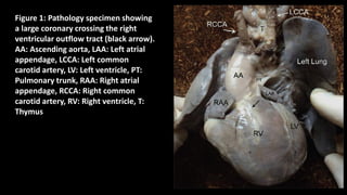Figure 1: Pathology specimen showing
a large coronary crossing the right
ventricular outflow tract (black arrow).
AA: Ascending aorta, LAA: Left atrial
appendage, LCCA: Left common
carotid artery, LV: Left ventricle, PT:
Pulmonary trunk, RAA: Right atrial
appendage, RCCA: Right common
carotid artery, RV: Right ventricle, T:
Thymus
 