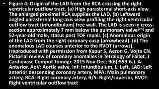 • Figure 4: Origin of the LAD from the RCA crossing the right
ventricular outflow tract. (a) High parasternal short-axis view.
The enlarged proximal RCA supplies the LAD. (b) Leftward
angled parasternal long-axis view profiling the right ventricular
outflow tract (infundibulum) free wall. The LAD is seen in cross-
section approximately 7 mm below the pulmonary valve[25] and
52-year-old male, status post TOF repair. (c) Anomalous origin
of the LAD from the right coronary cusp (arrowhead). (d) The
anomalous LAD courses anterior to the RVOT (arrows).
(reproduced with permission from Kapur S, Aeron G, Vojta CN.
Pictorial review of coronary anomalies in Tetralogy of Fallot. J
Cardiovasc Comput Tomogr. 2015 Nov-Dec; 9(6):593-6.). A:
Anterior, AoV: Aortic valve, Inf: Infundibulum, L: Left, LAD: Left
anterior descending coronary artery, MPA: Main pulmonary
artery, RCA: Right coronary artery, R/S: Right/superior, RVOT:
Right ventricular outflow tract
 