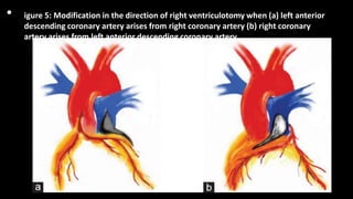 • igure 5: Modification in the direction of right ventriculotomy when (a) left anterior
descending coronary artery arises from right coronary artery (b) right coronary
artery arises from left anterior descending coronary artery
 